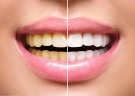COMBO LAPIZ BLANQUEADOR DENTAL